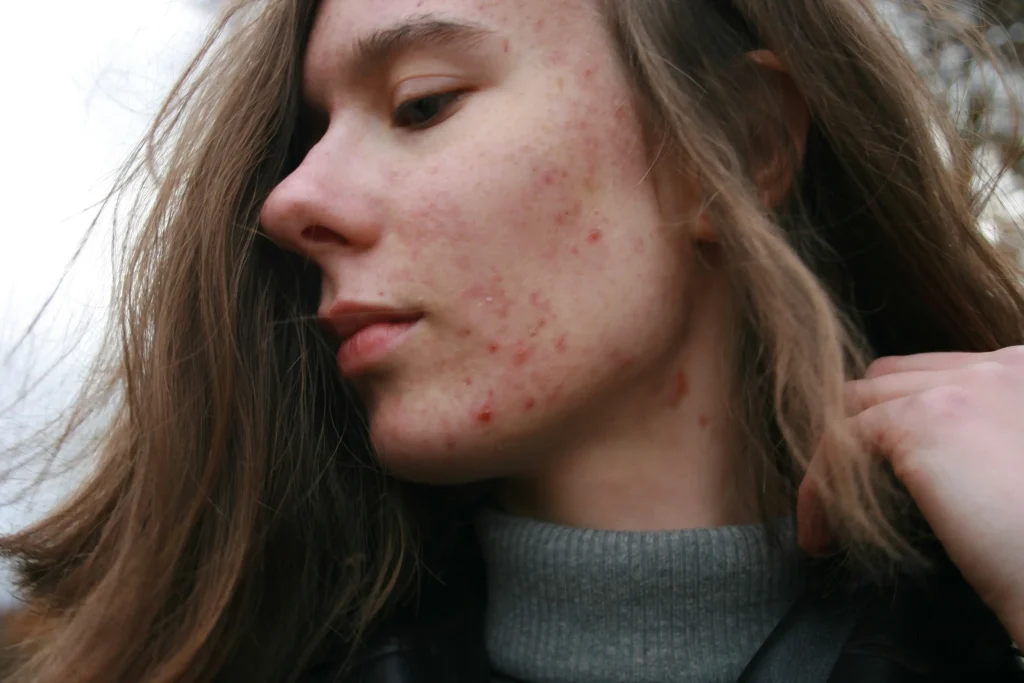 Why You Should NEVER Pop Pimples: 5 Risky Outcomes