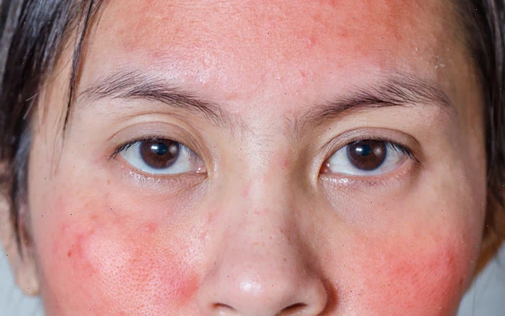 Why You Should NEVER Pop Pimples: 5 Risky Outcomes