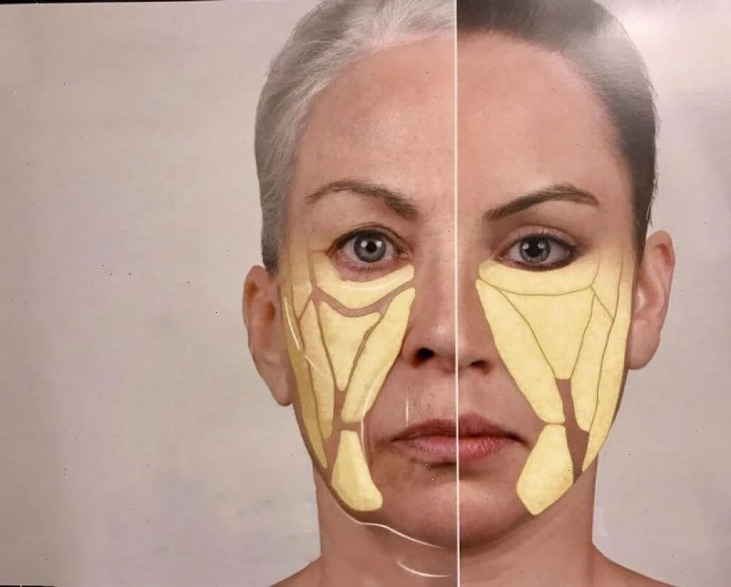 Reason #3: Deep Tissue Volume Loss
