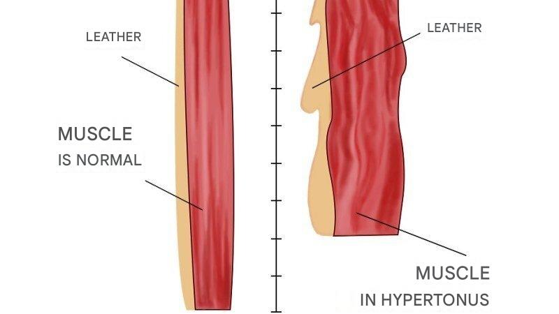 Reason #1: Muscle Overstrain Around the Mouth (Hypertonicity)